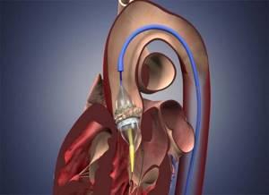 Протезирование аортального клапана позволяет продлить жизнь пациенту на несколько лет