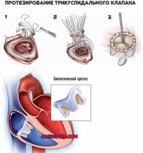 Митральный клапан после операции. Трикуспидальный клапан стеноз. Протезирование аортального клапана схема. Пластика митрального клапана операция. Митральный и аортальный клапан.