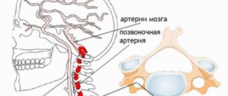 Правая позвоночная артерия. Защемления при шейном остеохондрозе артерии. Позвоночные артерии кровоток ускорен. Защемление артерии в позвоночнике. Асимметрия кровотока в позвоночных артериях.