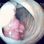 Рак прямой кишки