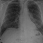 Расширение сердца влево