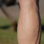 dilation of veins in the legs
