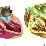 Различие между нормальной формой левого желудочка (1) и аневризмой (2)