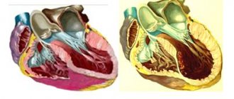 Различие между нормальной формой левого желудочка (1) и аневризмой (2)