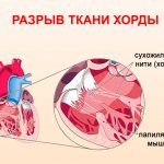 Разрыв нитей хорды