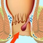 Развитие геморроя