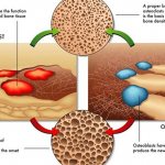 Ремоделирование костной ткани.