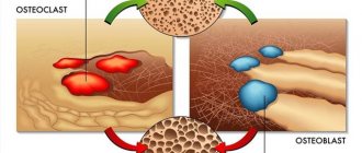 Ремоделирование костной ткани.