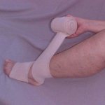 Рисунок 13. Ошибка 1. Неправильная перевязка голени.