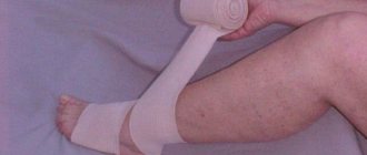 Рисунок 13. Ошибка 1. Неправильная перевязка голени.