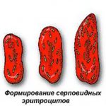 Серповидноклеточная анемия. Что это такое, причины, симптомы и лечение, тип наследования