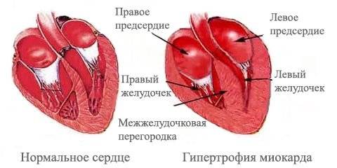 Схема гипертрофии левого желудочка сердца