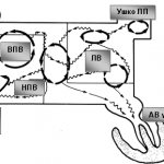 Схематическое изображение механизма развития мерцательной аритмии