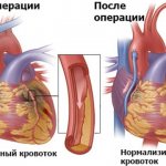 Шунтирование сердца. Что это такое, сколько живут, операция, противопоказания