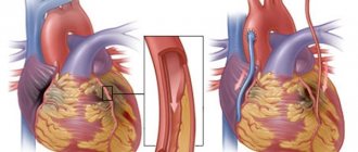 Heart bypass surgery. What is it, how long do they live, surgery, contraindications