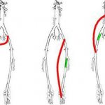 шунтирование сосудов нижних конечностей