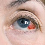 Симптомы кровоизлияния в глазу