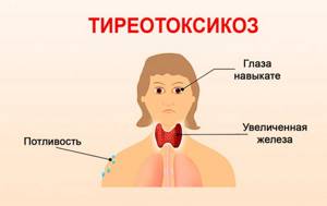 Симптомы тиреотоксикоза