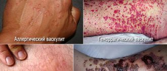 Симптомы васкулита