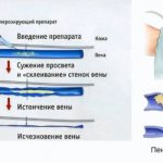 Склеротерапия