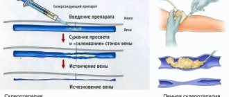 Склеротерапия