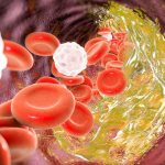 Склеротические бляшки в сосудах