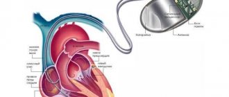 сколько живут с кардиостимулятором сердца