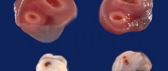 Сосуды пуповины