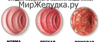 Стадии язвенного колита кишечника