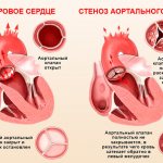 Стеноз клапана аорты