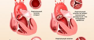 Aortic valve stenosis