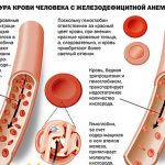 структура крови при скрытой анемии