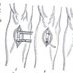 Техники катетеризации бедренной вены