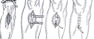 Femoral vein catheterization techniques