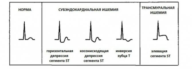 Повреждение миокарда на экг что это