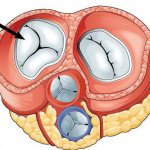 трикуспидальный клапан недостаточность