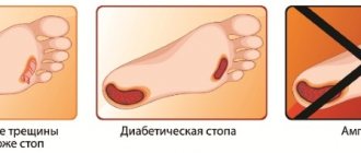 Трофические язвы на ногах. Фото, лечение, почему образуются, чем мазать