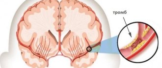 тромб