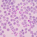 Тромбоцитопатия