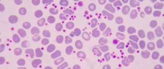 Тромбоцитопатия