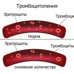 Thrombocytopenia during pregnancy low platelet count