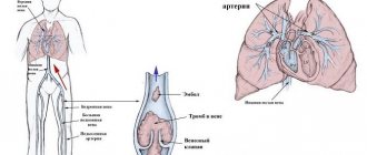 Тромбоэмболия легочной артерии
