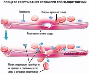 Почему синяки появляются от малейшего прикосновения на телефоне