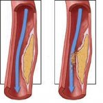 тромбоз коронарной артерии