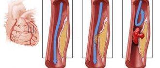 coronary artery thrombosis