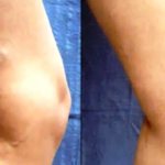 Тромбоз вен: до и после лечения