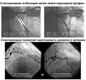 Что такое стент на сердце после инфаркта фото