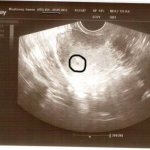 УЗИ на ранних сроках беременности