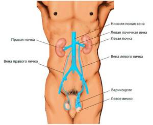 Варикоцеле у мужчин симптомы причины лечение в Николаеве Уролог ...