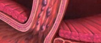 Varicose veins of the stomach and esophagus